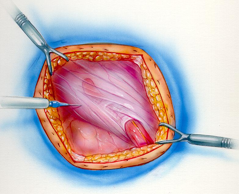 Fascial Hernia