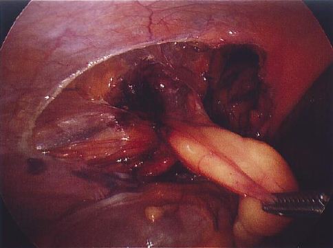 Fascial Hernia