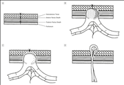 Fascial Hernia