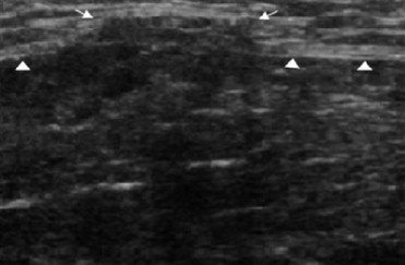 Fascial Hernia Calf