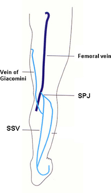 Fascial Hernia Calf