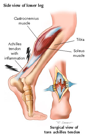 Fascial Hernia Calf Treatment