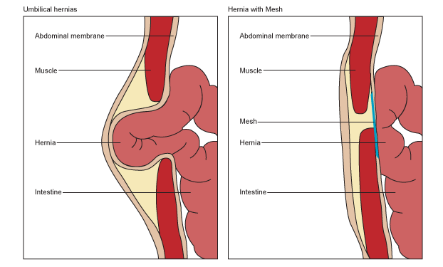 Fascial Hernia Leg