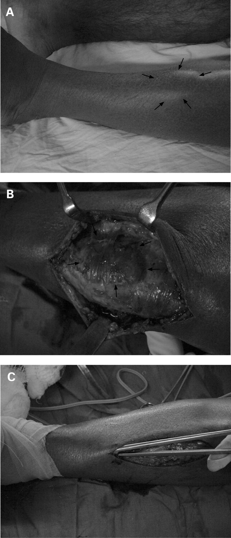 Fascial Hernia Leg