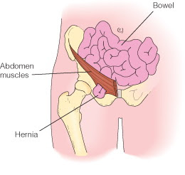 Fascial Hernia Leg