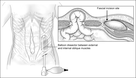 Fascial Hernia Leg