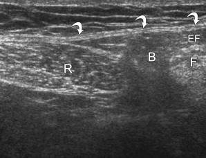 Fascial Hernia Lower Leg