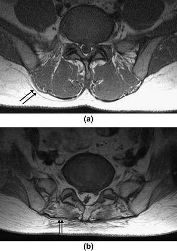 Fascial Hernia Shin