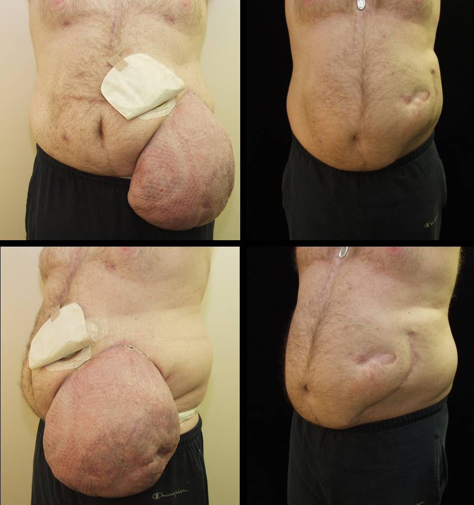 Fascial Hernia Surgery