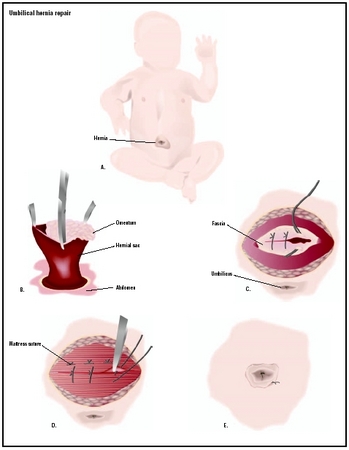 Fascial Hernia Treatment