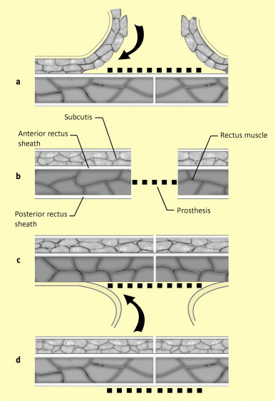 Fascial Hernia Treatment