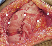 Fascial Hernia Treatment