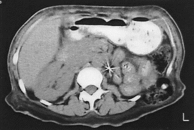 Fascial Herniation