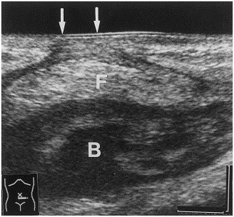 Fascial Herniation