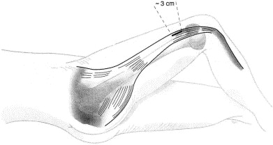 Fascial Herniation In Lower Leg