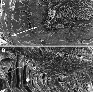 Fascial Herniation In Lower Leg