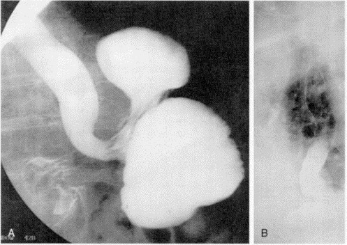 Intrathoracic Upside Down Stomach