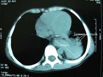 Intrathoracic Upside Down Stomach