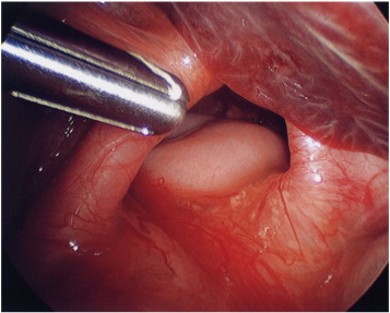 Intrathoracic Upside Down Stomach