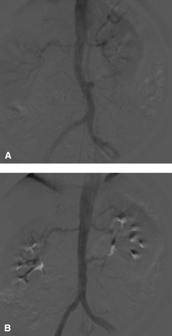 Intrathoracic Upside Down Stomach