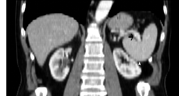 Upside Down Stomach Valve